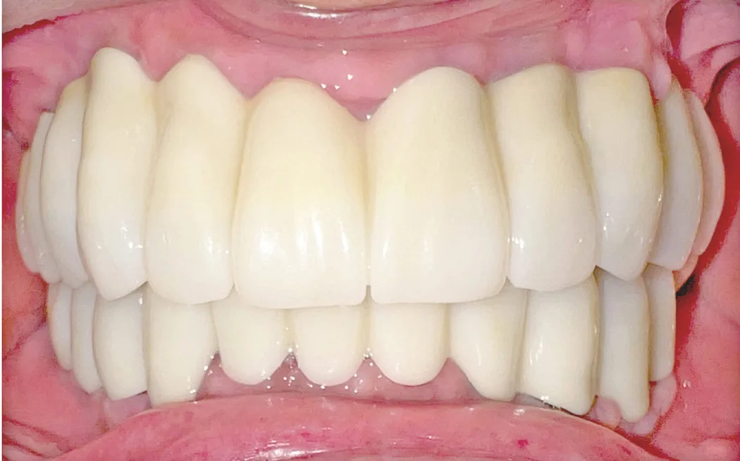 60代男性のインプラント（歯24本分）：治療後