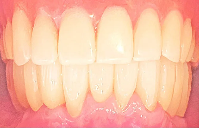 70代女性のインプラント（歯7本分）：治療後