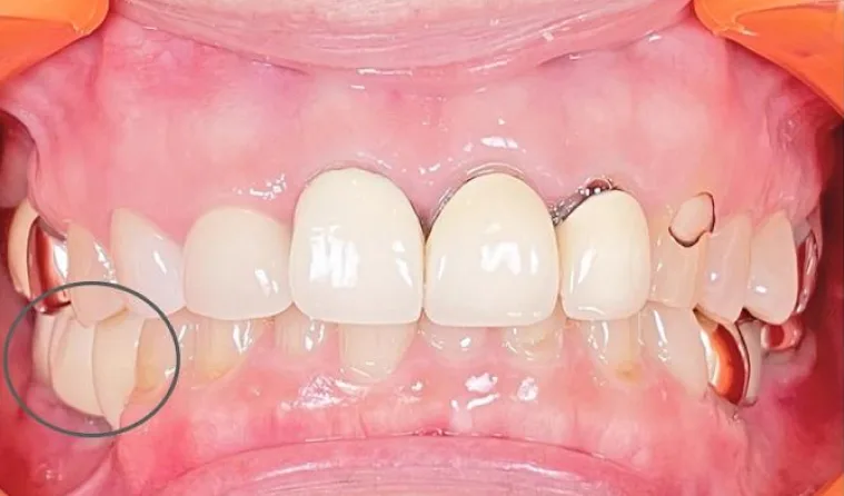 70代女性のインプラント（歯3本分）：治療後